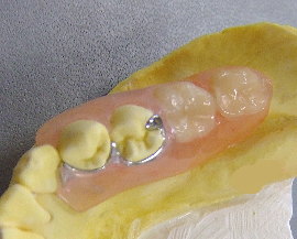 ノンクラスプ金属補強義歯